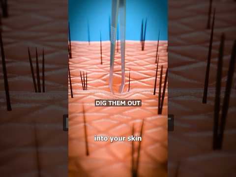 How Splinters Get Unstuck 😲 Surgeon Reacts