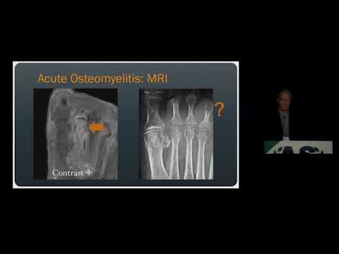 Imaging of Osteomyelitis & Septic Arthritis | 15 Minute Radiology CME