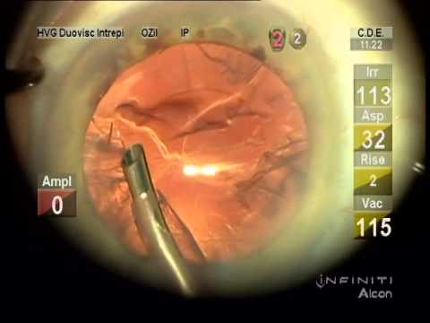 Routine Cataract Surgery Resident Teaching