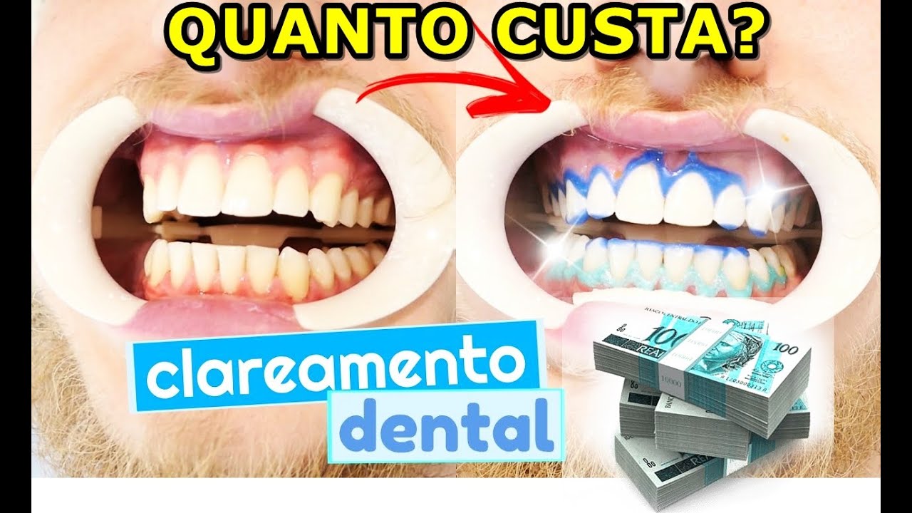 Watch Now Qual preço de um clareamento dentario Qual preço de um clareamento dentario