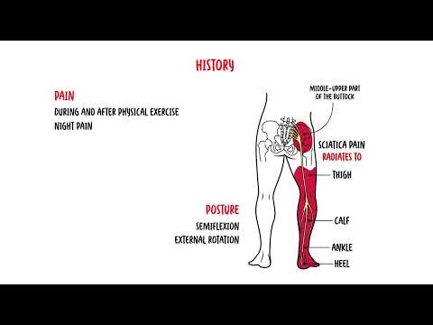 Zespół mięśnia gruszkowatego: przyczyny i sposoby leczenia