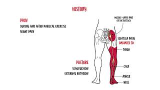 Piriformis Syndrome (buttock pain, siatica)