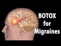BOTOX for Migraines, Animation.