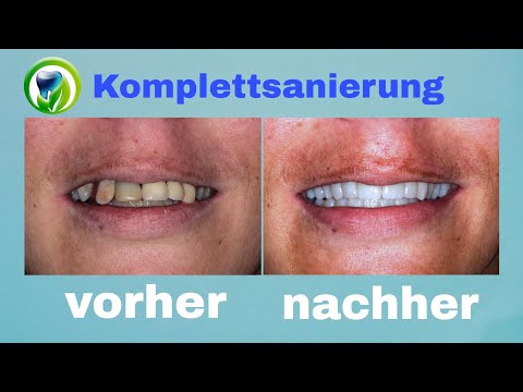 vorher - nachher Komplettsanierung | fester Zahnersatz und Knochenaufbau mit Bindegewebstransplantat