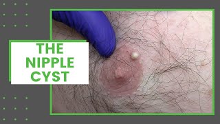 The Nipple Cyst | Dr. Derm