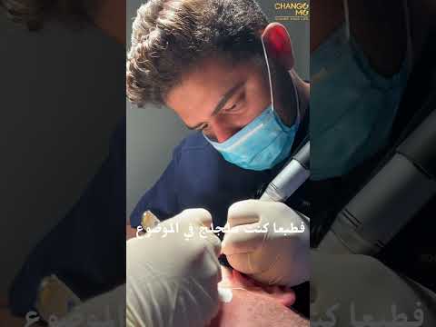 hair transplant review in Egypt change me