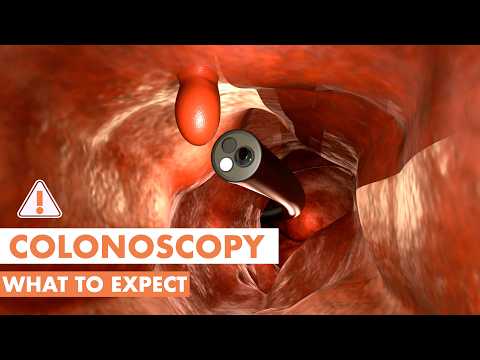 What Happens During a Colonoscopy? | 3D animation