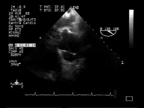 Rozwarstwienie aorty wstępującej w echokardiografii przezprzełykowej (1/3).