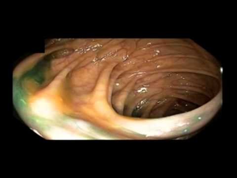 Diverticulosis del lado derecho, tinta de tatuaje antigua y adenoma tubular benigno