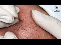 Best Blackhead Removal Ever 55min - Facial Acne Treatment - Gà Spa Best Blackhead Removal Ever 55min - Facial Acne Treatment - Gà Spa