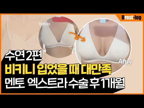 가슴성형 브이로그 2편 | 당일부터 한달까지 통증/모양/촉감까지 | 윈느성형외과 라벨윈느 유튜브 영상