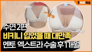 隆胸 Vlog 第2集 — 当天到1个月疼痛、形态、触感记录 | UNE 整形外科 — La Belle Une 视频频道