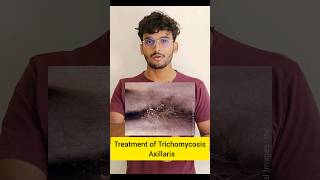Treatment of Trichomycosis Axillaris #dermatology #skincaretips #shorts  #skininfection #ytshorts