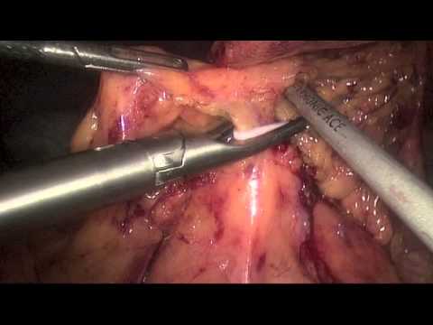 Laparoscopic Panproctocolectomy and Ileo-Anal Pouch in Ulcerative Colitis