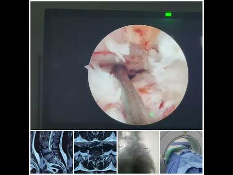 Endoscopic spine surgery with navigation