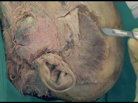 1.5 Step 3. Reflection of temporalis muscles