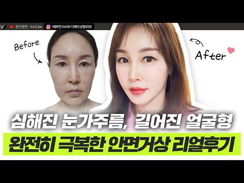 10년 전 얼굴로 완벽하게 돌아간 9개월 차 안면거상 후기 브이로그ㅣ디에이성형외과ㅣ브이라인변신후기