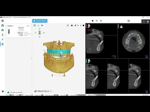 Atomica Implant Planner and Guide Design - AI Digital Dentistry Solutions