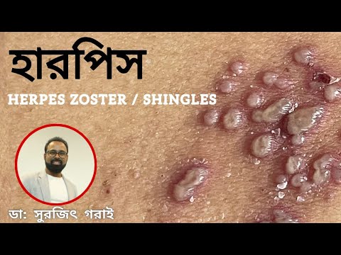 Herpes. HERPES ZOSTER | SHINGLES |Dr Surajit Gorai