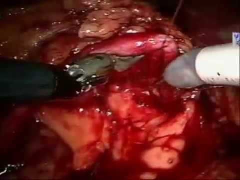 Reconstruction Of The Renal Pelvis Using A Robotic-Assisted Method