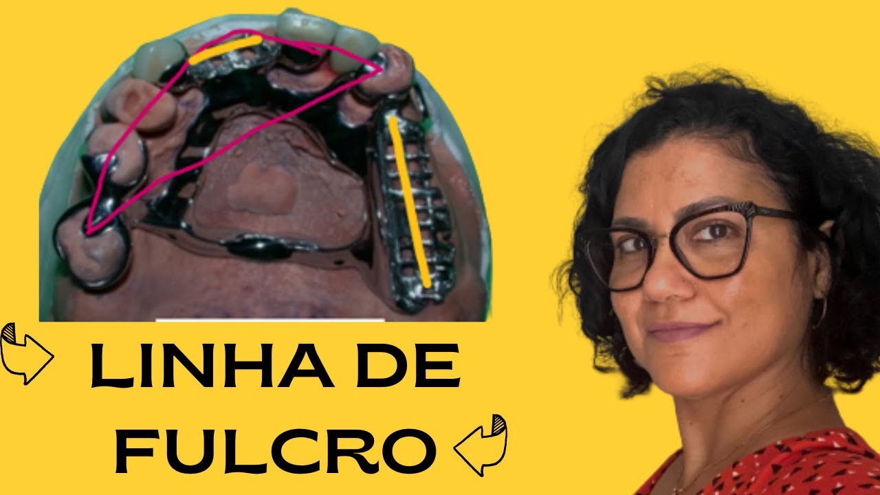 Linha de Fulcro em PPR