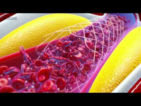 Logo of Precision Liposuction Procedure in Bangkok, Thailand for Targeted Body Contouring