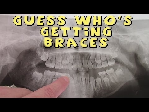 GUESS WHO'S GETTING BRACES Video