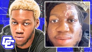 OG Maco Talks About Living With A Flesh-Eating Disease