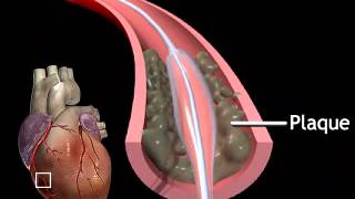 Balloon angioplasty   short segment   Anatomy Video  MedlinePlus Medical Encyclopedia