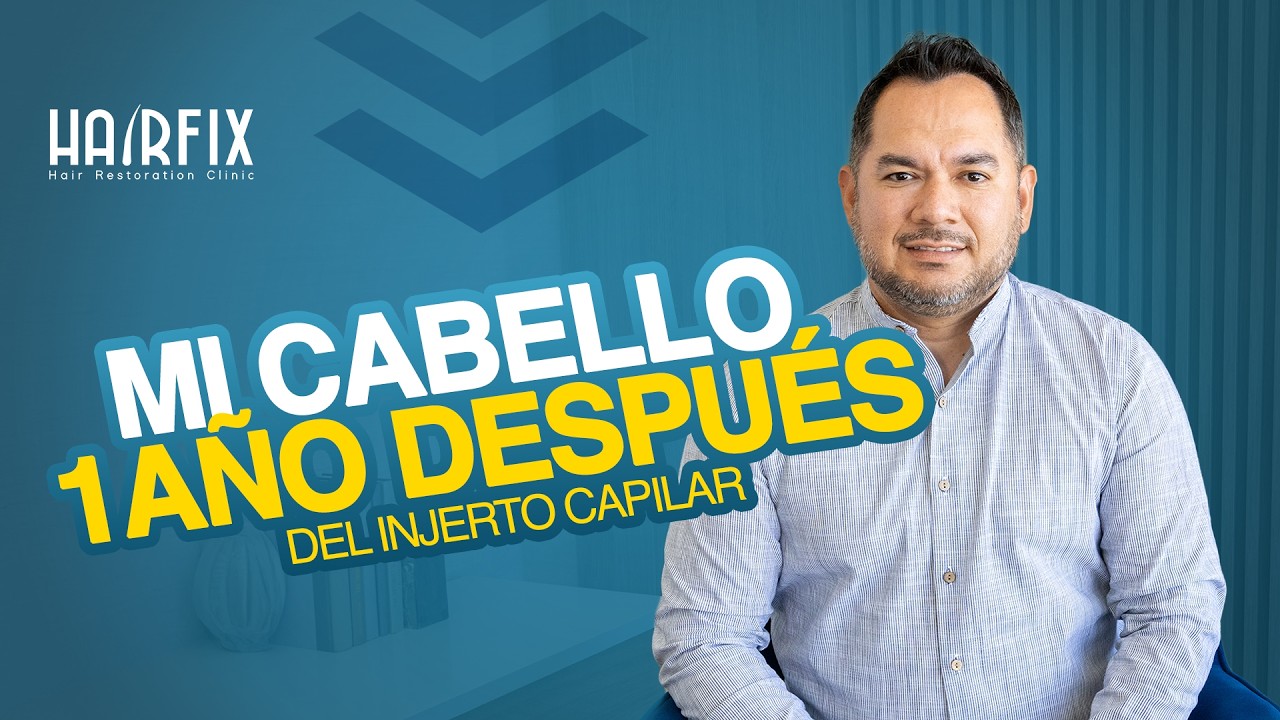 Mi Resultado 1 Año Después del Injerto Capilar | Harfix Tijuana