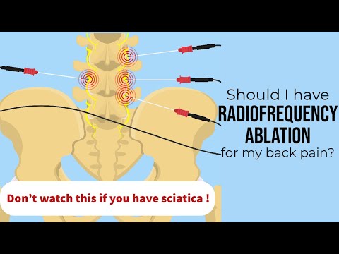 Spine surgeon: When radiofrequency ablation is the right treatment for your low back pain.