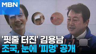 [정치톡톡] 조국, 눈에 시퍼런 멍든 사진 공개…실핏줄 터진 김용남