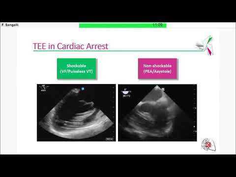 F  Sangalli - TEE (TransEsophageal Echocardiography) for non-cardiac anesthesiologists