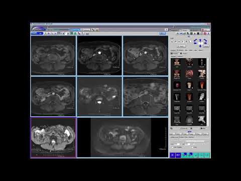 A companion hemangioma in an unusual spot (Victoria Chernyak)