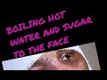 BOILING HOT SUGAR AND WATER TO THE FACE #jail #jailstories