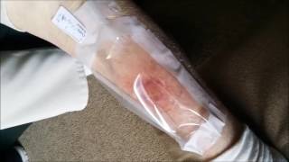 20170412 Audrey  Leg ulcer