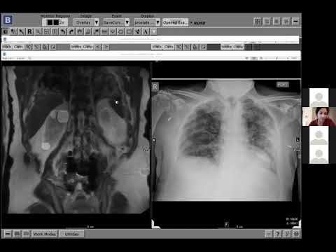 COVID-19 on abdominal MRI - Dr. Victoria Chernyak