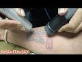 TATTOO REMOVAL IS PAINFUL!!! 