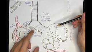 Vídeo-Esquema - Patologias Respiratórias: ASMA, DPOC, SDRA