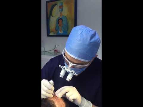 Dr. Fares Seffen - Greffe de cheveux FUE en Tunisie