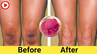 How To Get Rid Of Dark Pores On The Legs Early