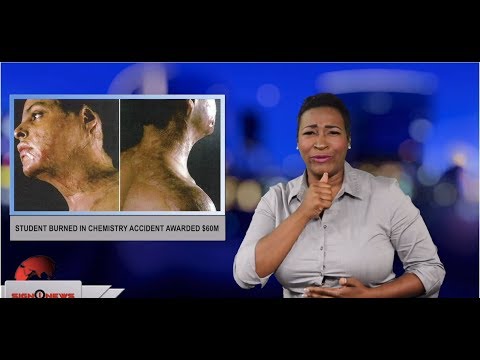 Student burned in chemistry accident awarded $60M (ASL - 7.3.19)