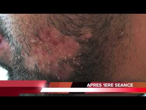 comment soigner verrue visage