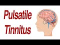 Pulsatile Tinnitus: 7 Different Anatomic Causes of Hearing Pulsations in the Ear