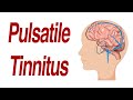 Pulsatile Tinnitus 7 Different Anatomic Causes Of Hearing Pulsations In The Ear