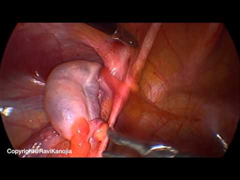 Laparoscopic Findings in Testicular Feminization Syndrome