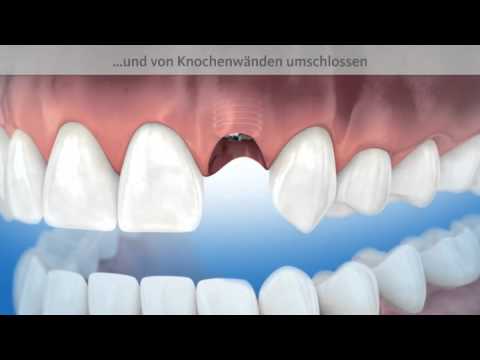 Praxis Dr. Erhard - Knochenaufbau um ein Zahnimplantat