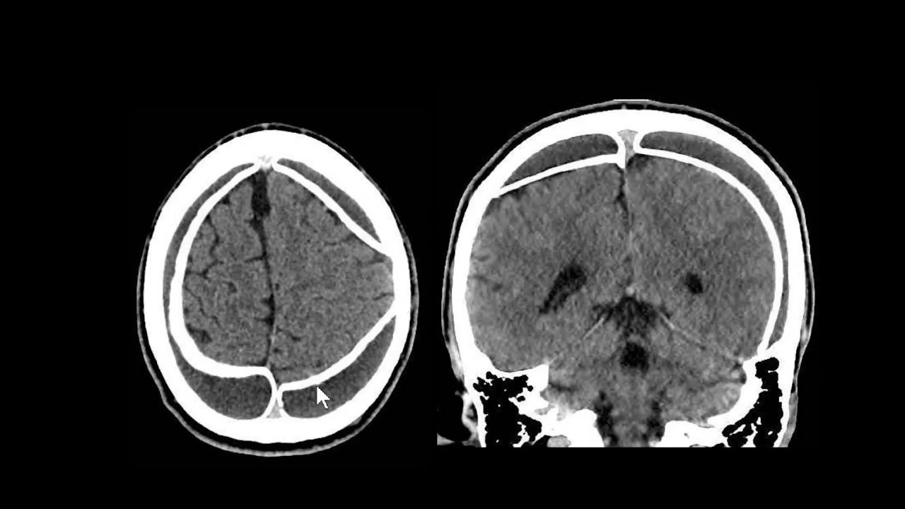 Hematoma subdural crônico calcificado