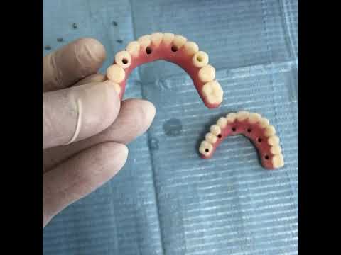 Dentadura Fixa - Prótese Protocolo - Tratamento completo de 5 dias. Vitória-ES