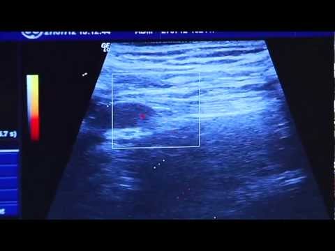 Dolore nel plchevom congiunta Osteocondrosi ritmo